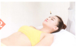 面神经麻痹拔罐