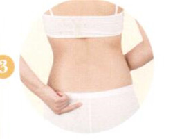 腰椎间盘突出拔罐