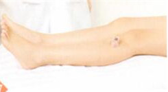 强直性脊柱炎拔罐