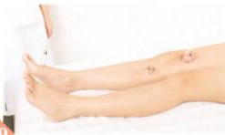 强直性脊柱炎拔罐