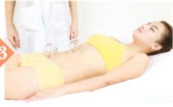 梅尼埃综合征拔罐