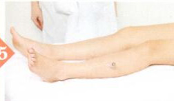 梅尼埃综合征拔罐