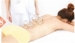 梅尼埃综合征拔罐