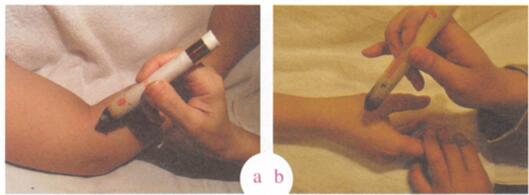 小儿长痱子艾灸