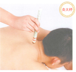 类风湿性关节炎艾灸