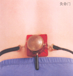 慢性腰肌劳损艾灸