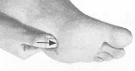 腰椎间盘突出症按摩