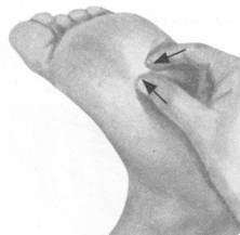 腰椎间盘突出症按摩