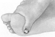 腰椎间盘突出症按摩