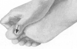 腰椎间盘突出症按摩