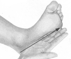 腰椎间盘突出症按摩