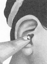 腰椎间盘突出症按摩