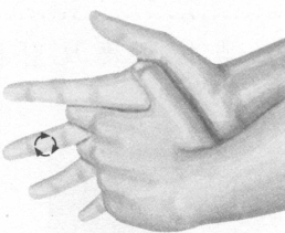 腰椎间盘突出症按摩