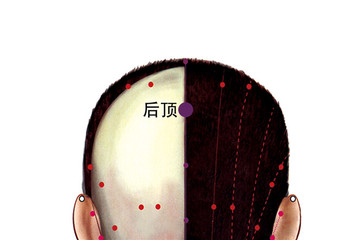 后顶穴